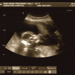 Mid-Pregnancy Scan 2