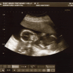 Mid-Pregnancy Scan 3